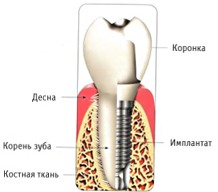 Экспресс-имплантация зубов в Санкт-Петербурге — справедливые цены, гарантия 5 лет!