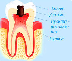 Лечение пульпита зубов в Санкт-Петербурге — справедливые цены, гарантия 5 лет!